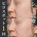 ピコスポット/シミ治療1回 after画像 サムネイル用