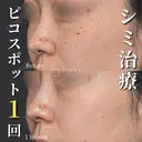 ピコスポット/シミ治療1回 after画像 サムネイル用
