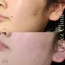 顔・身体OK３個20,000円！年間10万個ホクロ除去Dr在籍🐰当院人気No１ホクロ治療✨ before画像 サムネイル用