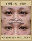 目の下ベビーコラーゲン注射 before画像 サムネイル用