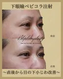 目の下ベビーコラーゲン注射 0日後 サムネイル用