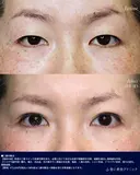 二重全切開 before画像 サムネイル用