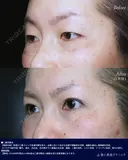 二重全切開 after画像 サムネイル用