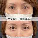 クマ取りと脂肪注入で目元のエイジングケア🐻 after画像 サムネイル用