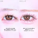 アリエルクイックループトリプル二重埋没法/瞼の上の脂肪取り before画像 サムネイル用