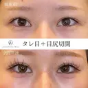 タレ目+目尻切開 before画像 サムネイル用