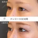 タレ目+目尻切開 14日後 サムネイル用