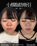 岩切医師による🔥小顔脂肪吸引🔥 90日後 サムネイル用