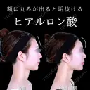 額ヒアルロン酸 7日後 サムネイル用