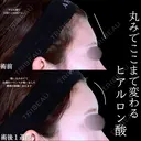 額ヒアルロン酸 before画像 サムネイル用