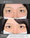 華やかなお目元に😌💖二重埋没法（自然癒着法） after画像 サムネイル用