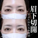 眉下切開 before画像 サムネイル用