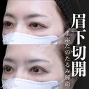 眉下切開 0日後 サムネイル用