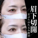 眉下切開 0日後 サムネイル用