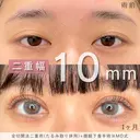 MD式全切開法二重術+MD式眼瞼下垂手術※たるみ取り併用 30日後 サムネイル用