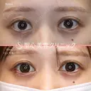 【20代女性・目頭目尻を横方向にしっかり伸ばしたい】目頭切開・目尻切開 after画像 サムネイル用