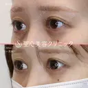 【20代女性・目頭目尻を横方向にしっかり伸ばしたい】目頭切開・目尻切開 after画像 サムネイル用