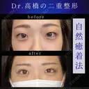二重埋没(自然癒着) before画像 サムネイル用