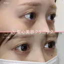 【20代女性・目頭目尻を横方向にしっかり伸ばしたい】目頭切開・目尻切開 after画像 サムネイル用