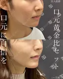 【切らない人中短縮】1か月後！もうマスクオフも怖くない！ 30日後 サムネイル用