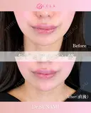 顎ヒアルロン酸 before画像 サムネイル用