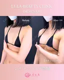 シリコンバッグ豊胸 7日後 サムネイル用