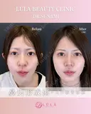 鼻尖形成術×耳介軟骨移植 90日後 サムネイル用