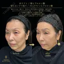 糸リフト・切らないクマ取り・頬ヒアルロン酸・目の下ヒアルロン酸 before画像 サムネイル用