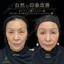 糸リフト・切らないクマ取り・頬ヒアルロン酸・目の下ヒアルロン酸 14日後 サムネイル用