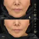 ほうれい線ヒアルロン酸 0日後 サムネイル用