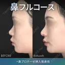 鼻フルコース（鼻複合自家組織移植術）＋鼻プロテーゼ挿入隆鼻術 before画像 サムネイル用