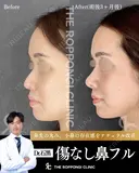 鼻先の丸み、小鼻の存在感をナチュラル改善 before画像 サムネイル用