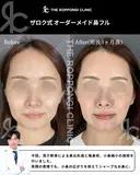 鼻先の丸み、小鼻の存在感をナチュラル改善 90日後 サムネイル用