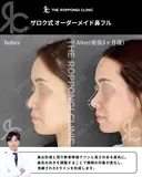 鼻先の丸み、小鼻の存在感をナチュラル改善 90日後 サムネイル用