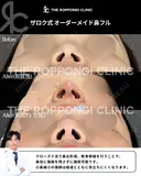 鼻先の丸み、小鼻の存在感をナチュラル改善 90日後 サムネイル用
