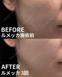 ルメッカ(3周) after画像 サムネイル用