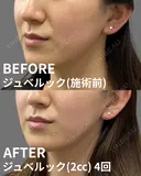 ジュベルック(2cc) before画像 サムネイル用