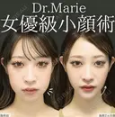 あごヒアルロン酸＋ジョール/バッカルファット除去＋エラボトックス＋糸リフト＋脱脂(クマ治療)＋脂肪吸引(下) before画像 サムネイル用