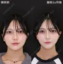 あごヒアルロン酸＋糸リフト＋ジョールファット除去＋エラボトックス before画像 サムネイル用