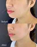 切らない顎形成 3D Eライン before画像 サムネイル用