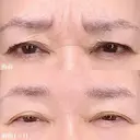 眉間ボツリヌストキシン注射 before画像 サムネイル用