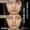 顔脂肪吸引 after画像 サムネイル用