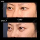 G 下眼瞼切開術（裏ハムラ法） before画像 サムネイル用