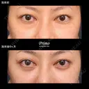 G 下眼瞼切開術（裏ハムラ法） 180日後 サムネイル用
