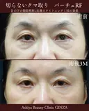 切らないクマ取り　バーチュRF （ニードルRF） before画像 サムネイル用