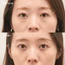 下眼瞼脱脂術（目の下のクマ・たるみ取り) after画像 サムネイル用