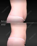 脂肪吸引でキュッと美くびれ✨ after画像 サムネイル用