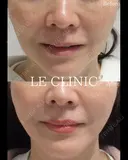 小顔デザインリフト before画像 サムネイル用