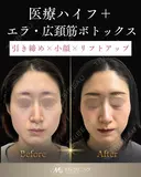 ウルトラフォーマーⅢ×エラボトックス×広頚筋ボトックスでフェイスラインをトータル改善✨ before画像 サムネイル用