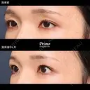 HP 眼瞼下垂手術＋下眼瞼拡大術＋目尻切開 before画像 サムネイル用